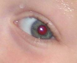Photo of a person with Red Eye